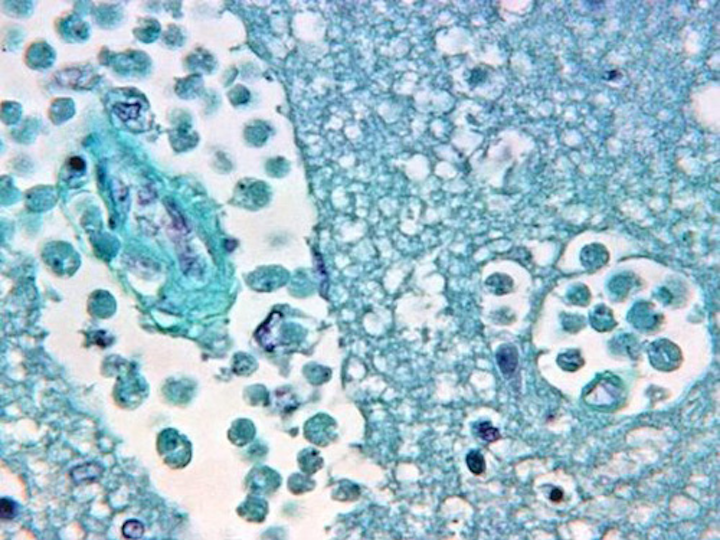 Naegleria fowleri in brain tissue. Photo: CDC